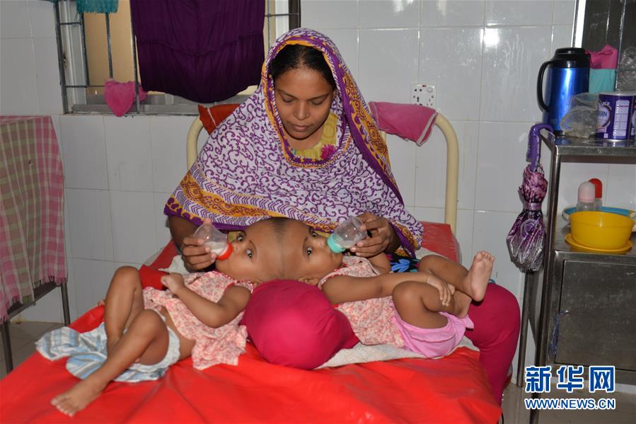 （XHDW）（2）孟加拉國頭部連體女嬰將準備接受分離手術