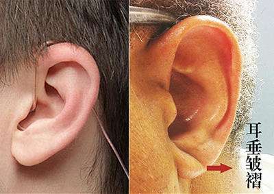 耳垂折痕可能是冠心病